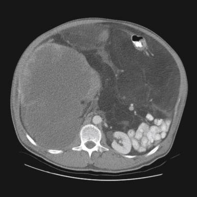 Fig. 2.2, Contrast-enhanced CT scan of a 52-year-old patient with retroperitoneal dedifferentiated liposarcoma. The CT findings illustrate features of both well-differentiated and dedifferentiated forms of liposarcoma that frequently coexist. The dedifferentiated component is the more solid-appearing, low-density mass situated in the right retroperitoneum, whereas the well-differentiated component has similar density to the subcutaneous (normal) fat and fills the retroperitoneum, displacing the contrast-filled small bowel to the anatomic left side and posterior.