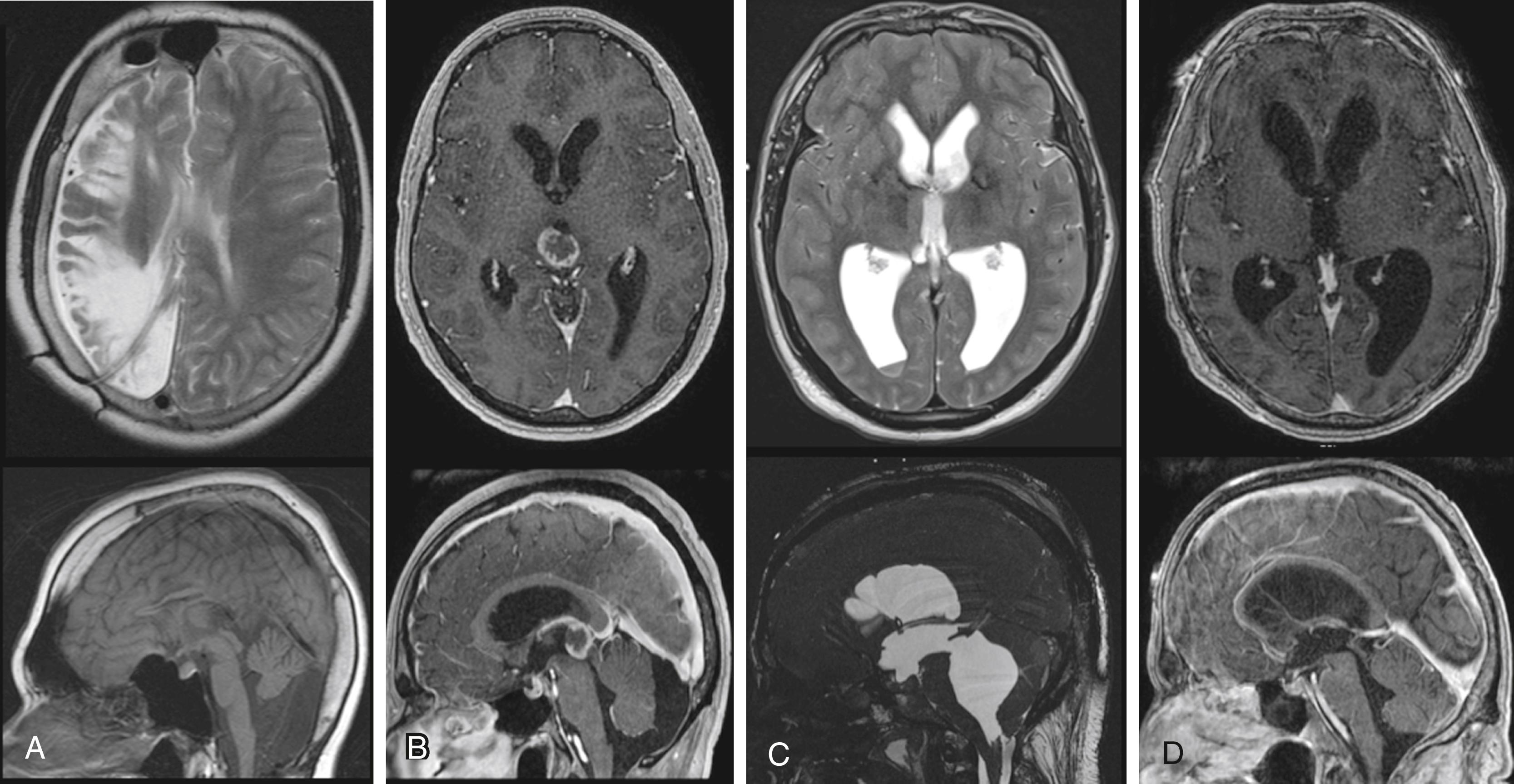 Figure 43.1, Representative axial MR images of hydrocephalic patients with transition (A), acquired (B), unrecognized congenital (C), and suspected idiopathic normal pressure (D) forms of hydrocephalus.