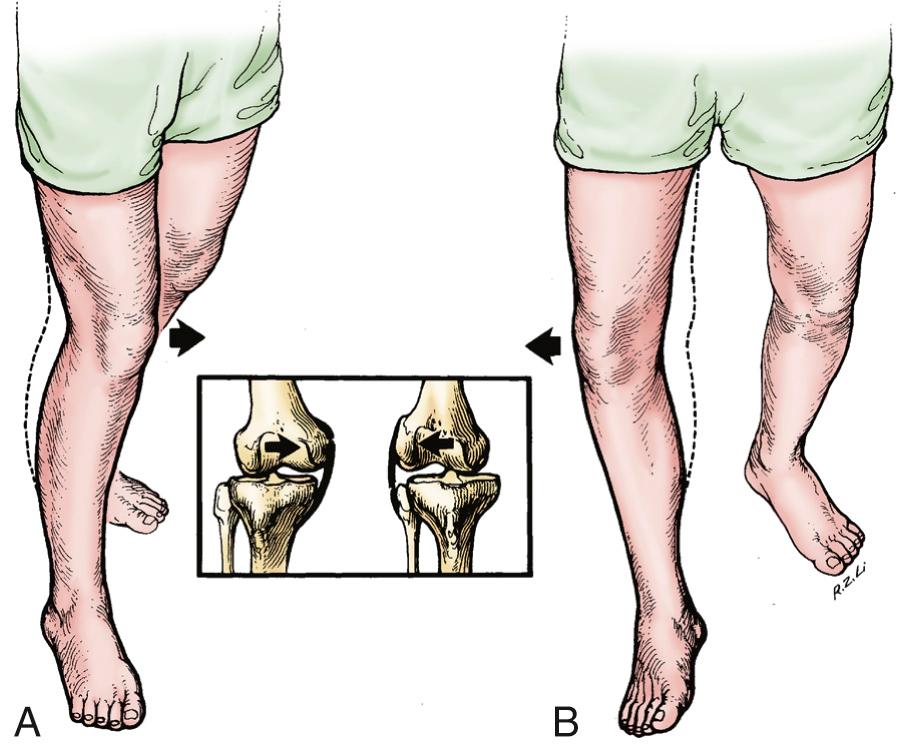 FIG 3.1, (A) Medial thrust of the femur indicates shift of the femur medially on the tibia through the stance phase of gait in the coronal plane. (B) Lateral thrust indicates lateral shift of the femur in the coronal plane.