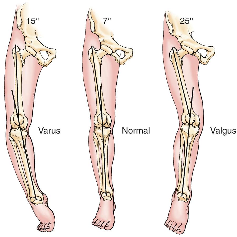 FIG 3.2, The anatomic axis is measured by drawing lines parallel to the long axis of the femur and the tibia and measuring the intercepting angle.