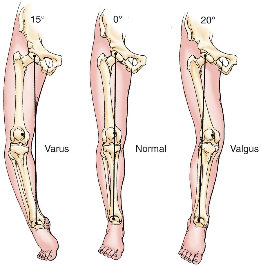 FIG 3.3, The mechanical axis of the leg is measured in the standing position with an imaginary “plumb line” dropped from the femoral head to the ground. This angular measurement gives the best functional evaluation of lower extremity alignment.