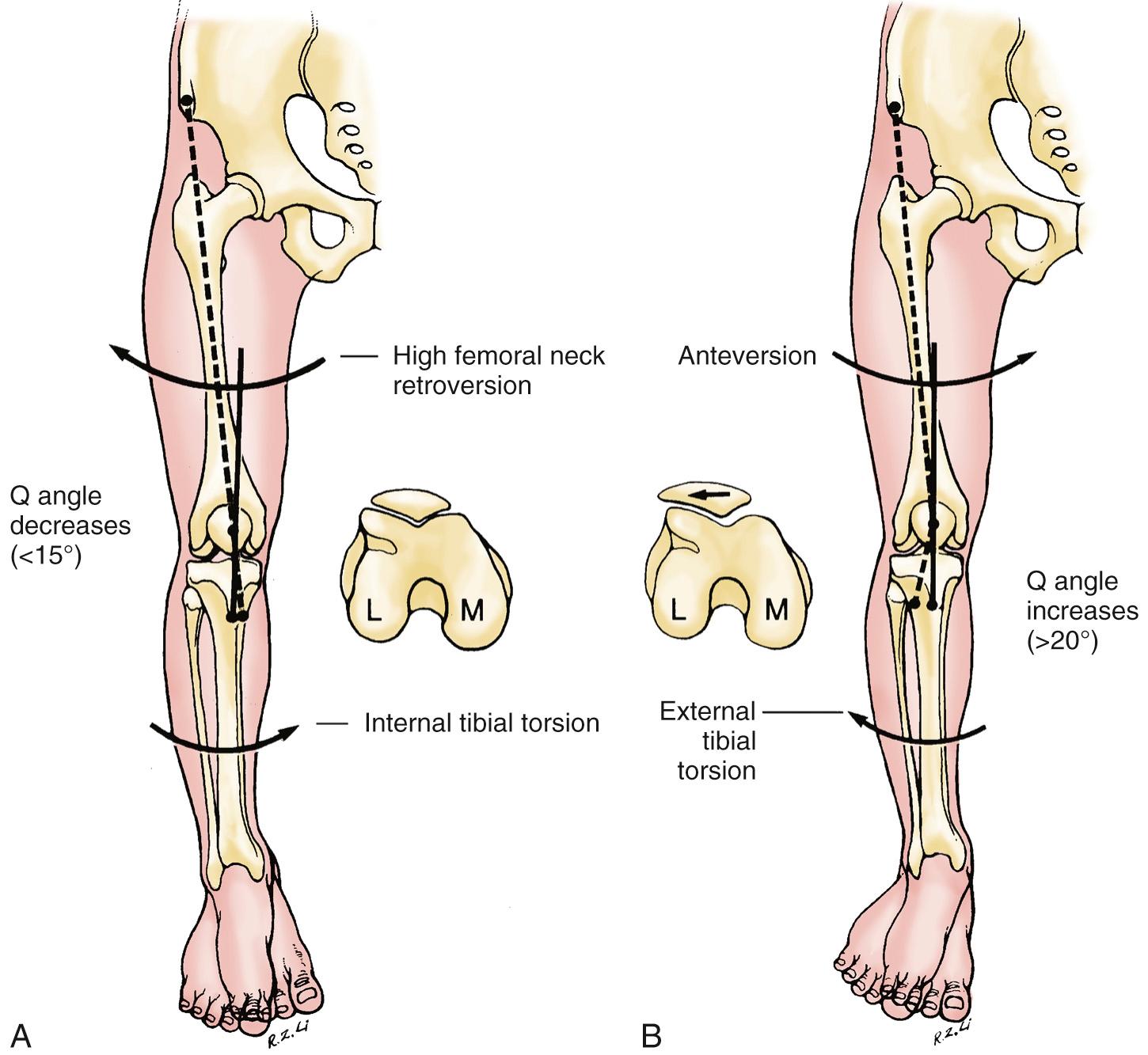 FIG 3.4, High femoral neck retroversion rotates the distal end of the femur externally. In combination with internal tibial torsion, the Q angle is decreased. Patellar tracking is improved, and patellofemoral sulcus alignment is normal. High femoral neck anteversion rotates the distal end of the femur internally. In combination with external tibial torsion, the Q angle is increased. Patellar tracking is compromised, and the patella tends to track laterally.