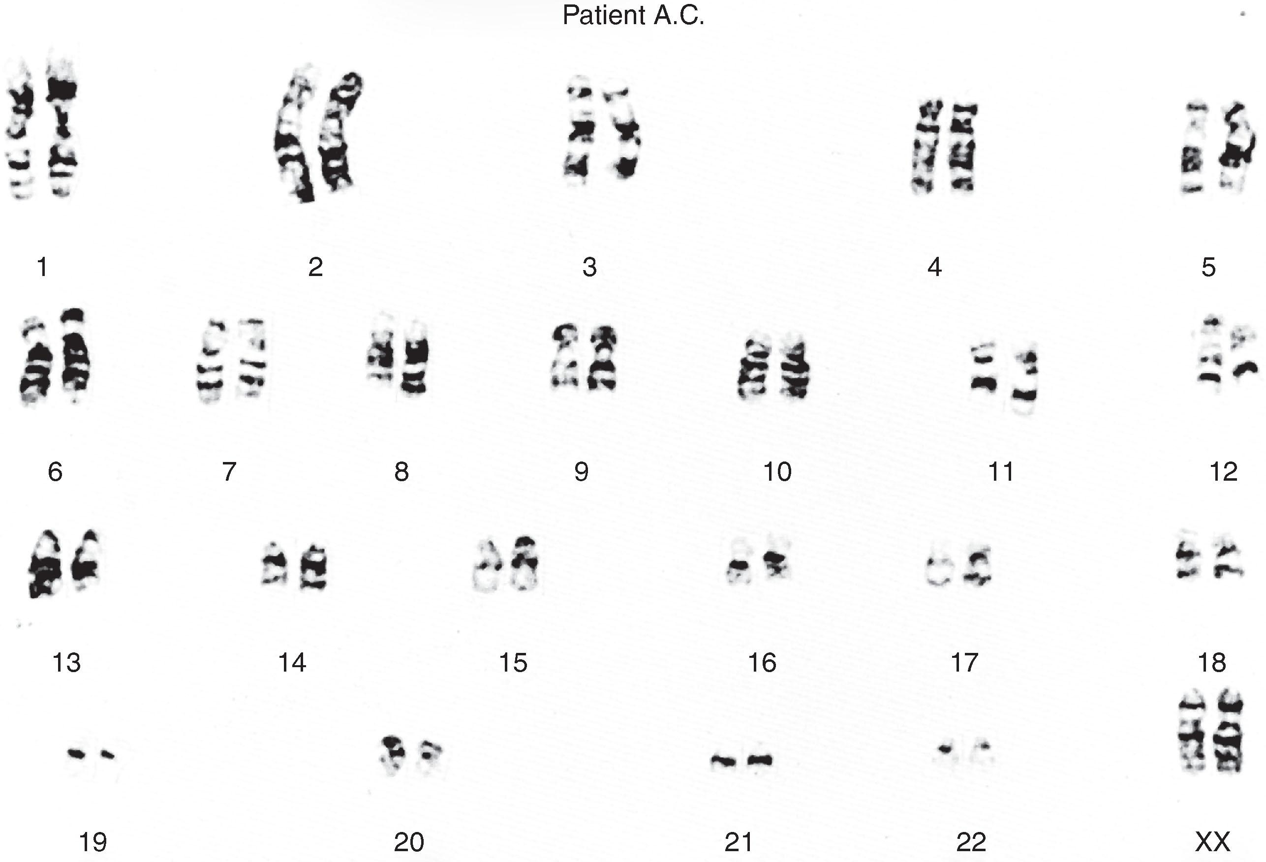 Fig. 2.1, A normal female 46,XX G-banded karyotype illustrating the banding patterns which permit identification of each individual chromosome.
