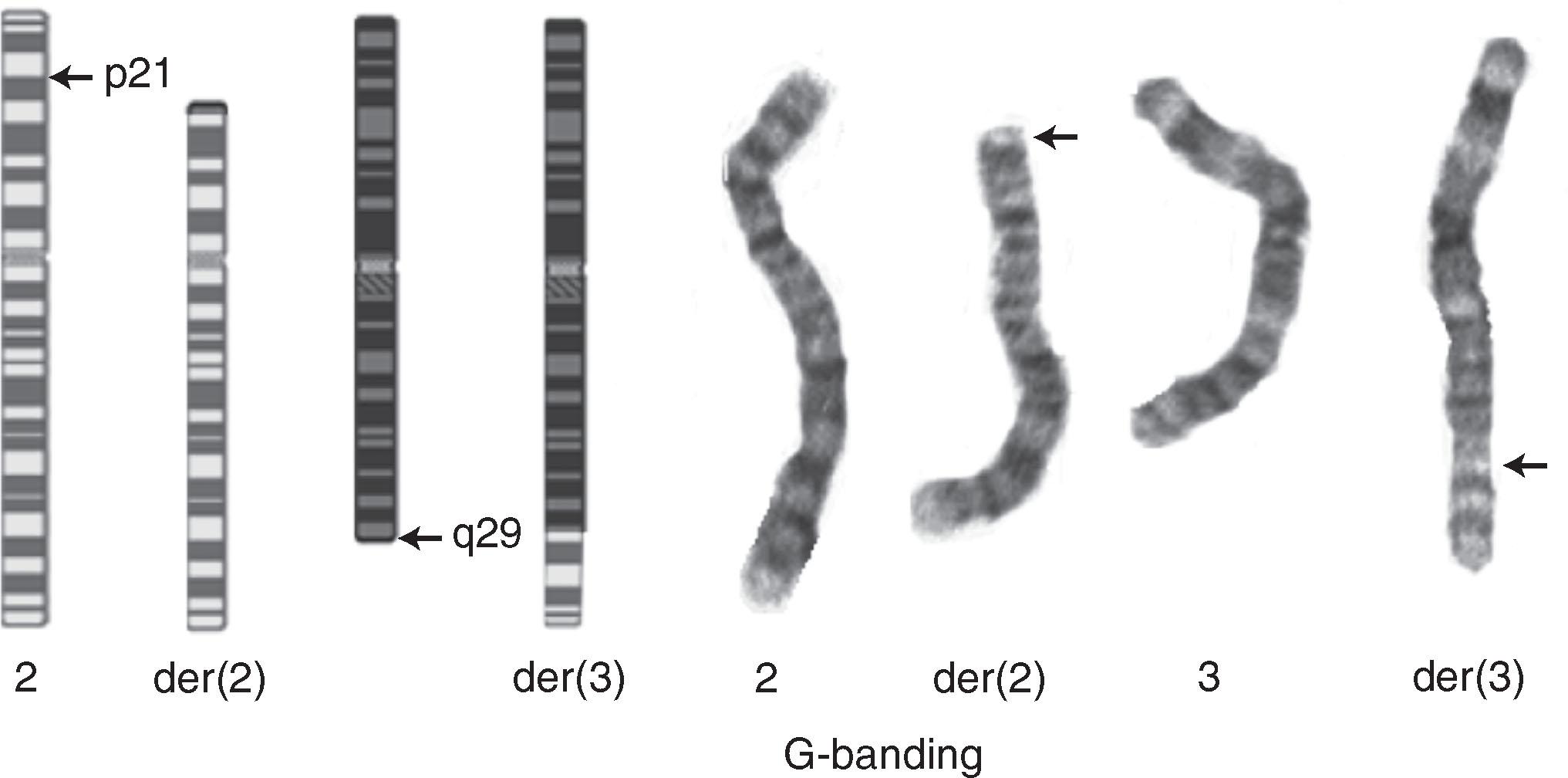 Fig. 2.2, Reciprocal translocation between chromosomes 2 and 3. A portion of the short arm of chromosome 2 has been exchanged with a small portion of the long arm of chromosome 3. The panel on the left shows this in diagrammatic form. The middle panel is the result of G-banding. The right panel shows chromosome painting. This is a balanced translocation.