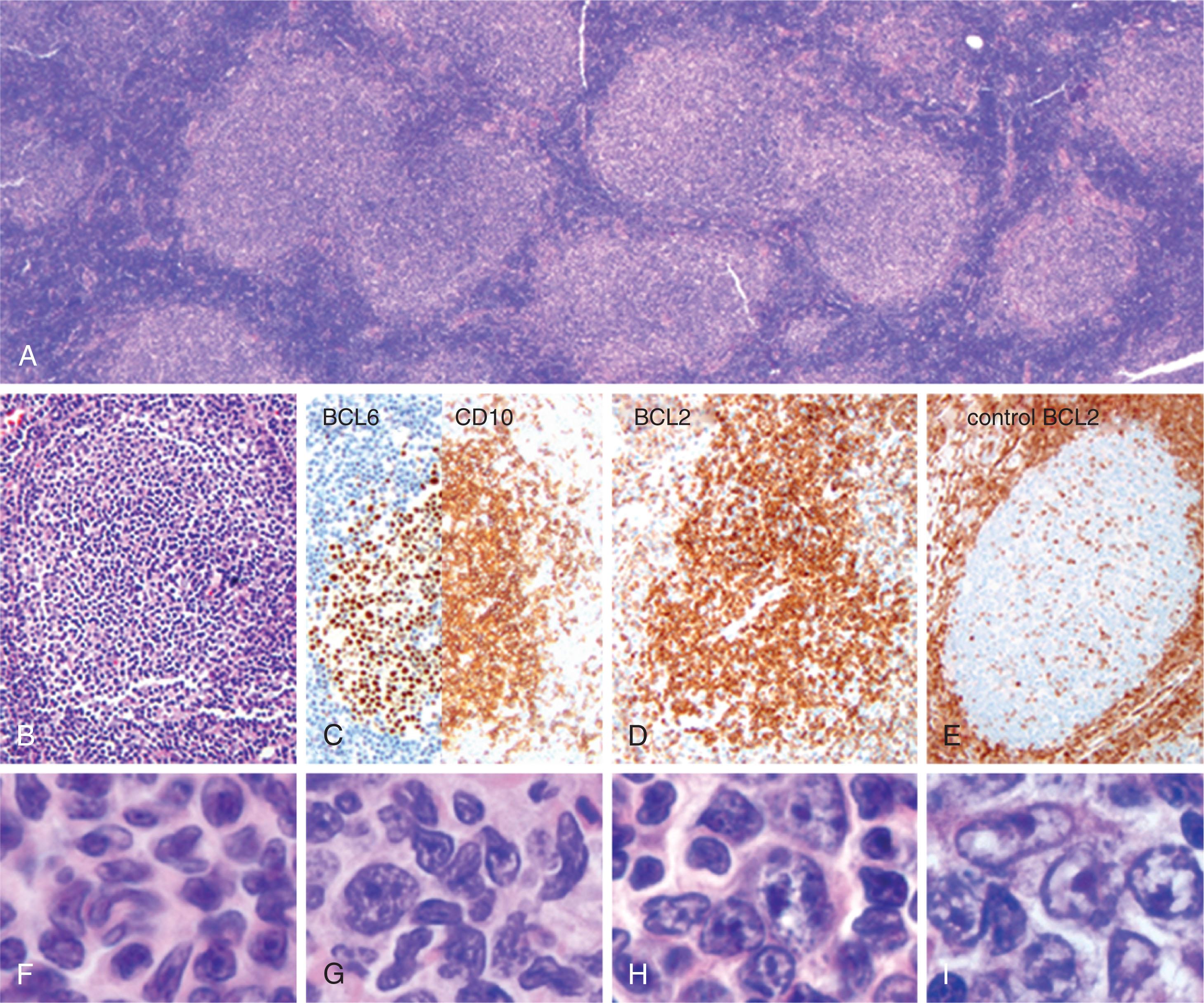 Figure 82.1, FOLLICULAR LYMPHOMA: MORPHOLOGIC AND IMMUNOPHENOTYPIC FINDINGS.