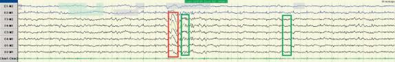 FIG. 4.4, Stage N2 (red rectangle demonstrates K-complex, and green rectangles show sleep spindles).