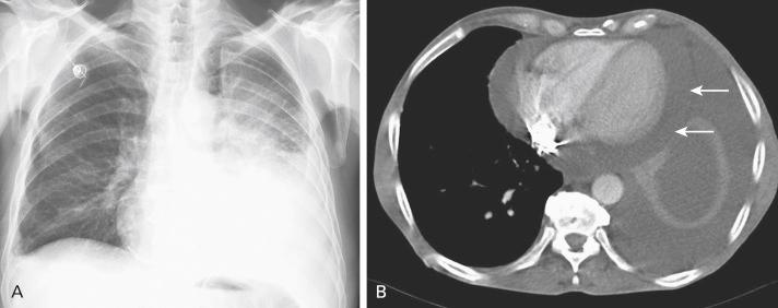 Fig. 20.1, Chest radiography (A) and chest computed tomography image (B) of a nonsmall cell lung cancer, showing a left-sided pleural effusion as well as a pericardial effusion (white arrows) in the same patient, caused by a lung adenocarcinoma of the left upper lobe.