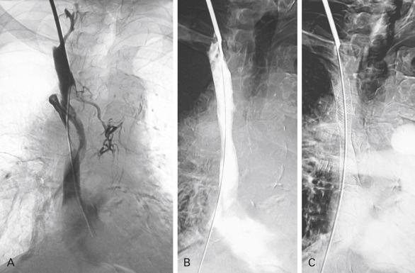 Fig. 20.2, (A) Subocclusion of the superior vena cava by a centrally located invasive lung cancer, resulting in clinical superior vena cava syndrome. (B–C) Reconstituted superior vena cava after percutaneous balloon dilatation and placement of endovascular stent.