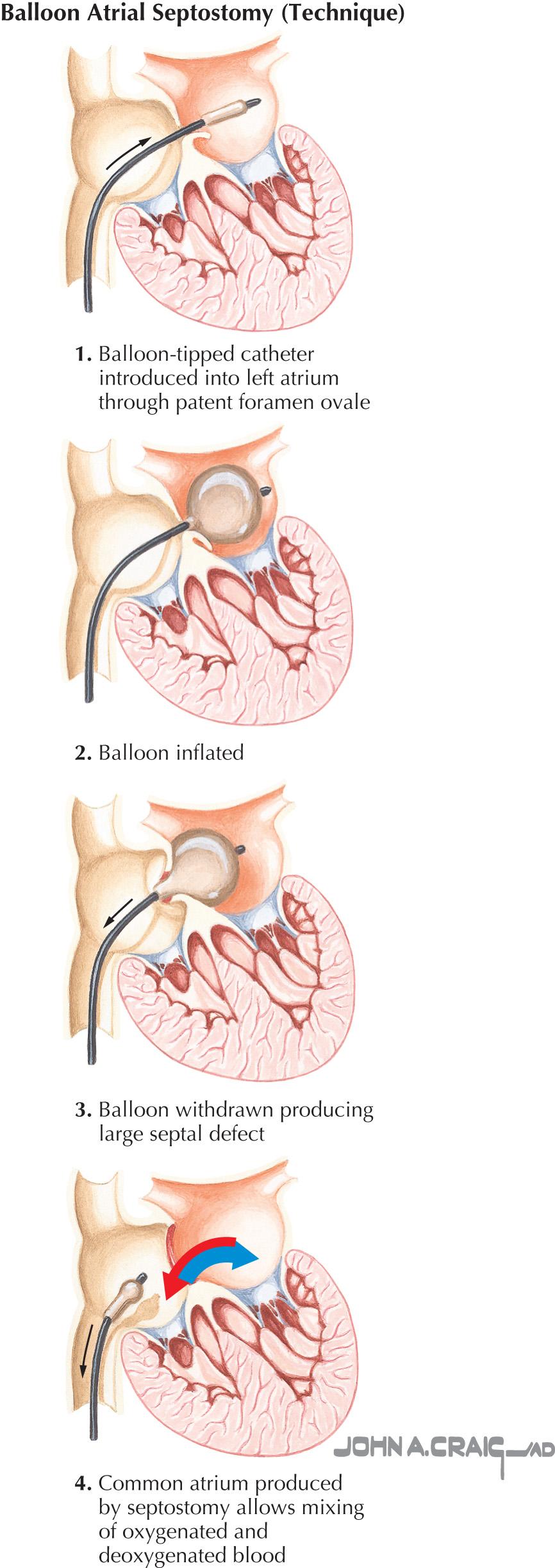 FIG 51.1, Transposition of the Great Arteries.