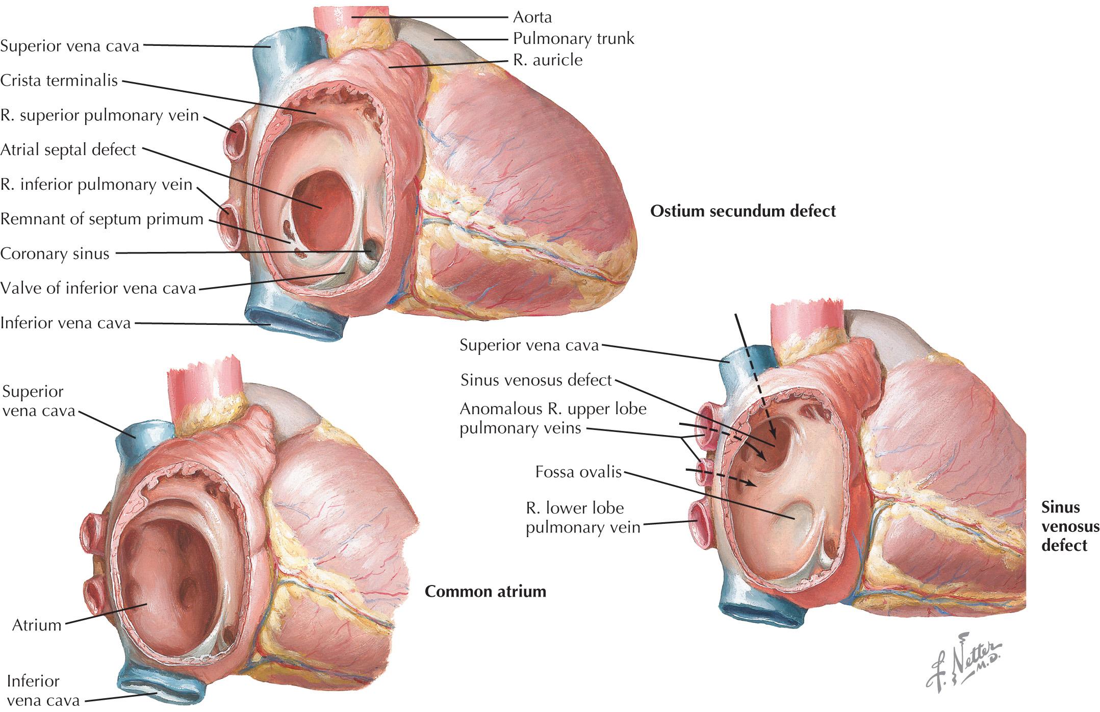 FIG 51.2, Defects of the Atrial Septum.