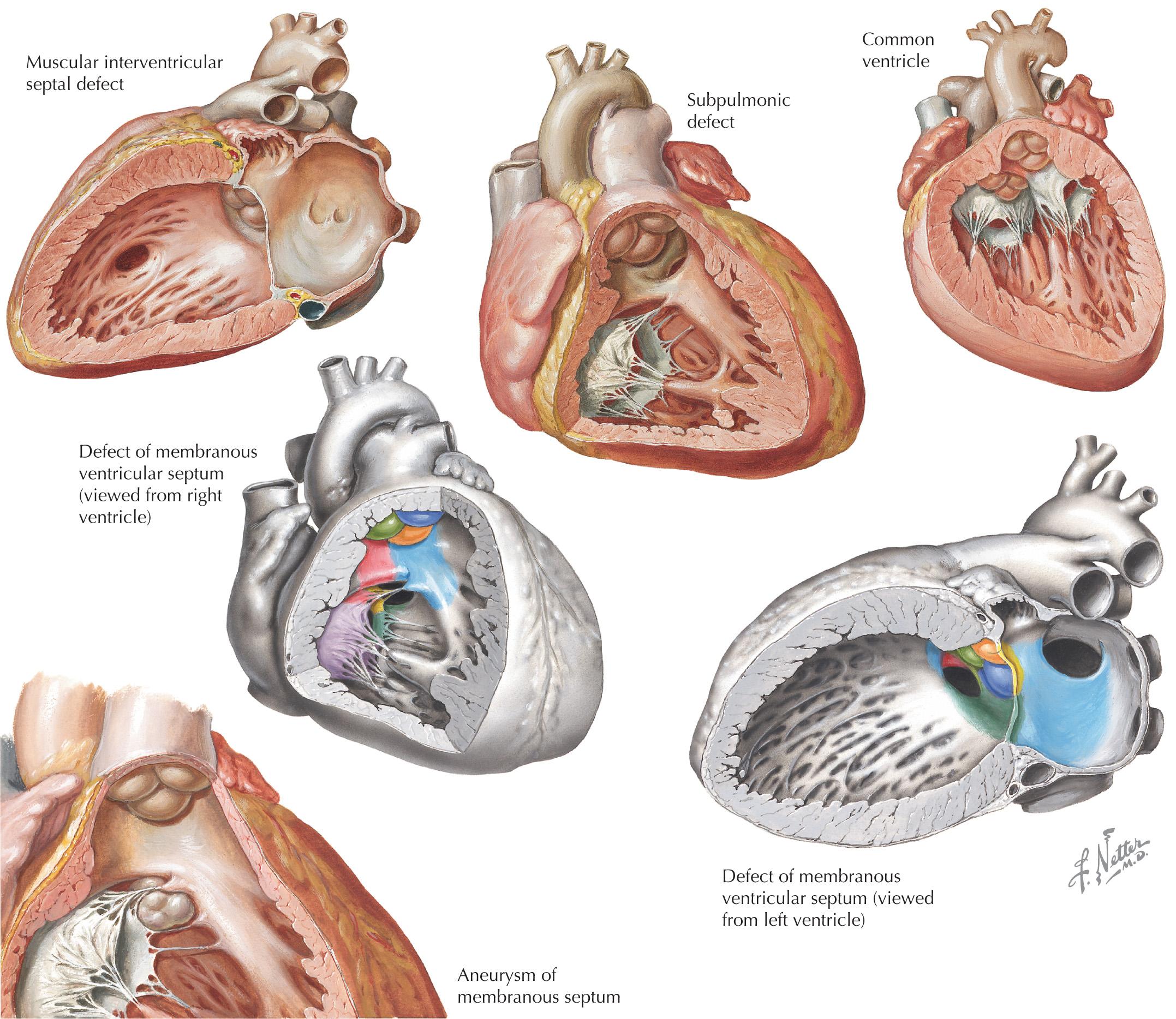 FIG 51.3, Anatomic Features of Perimembranous and Muscular Ventricular Septal Defects.