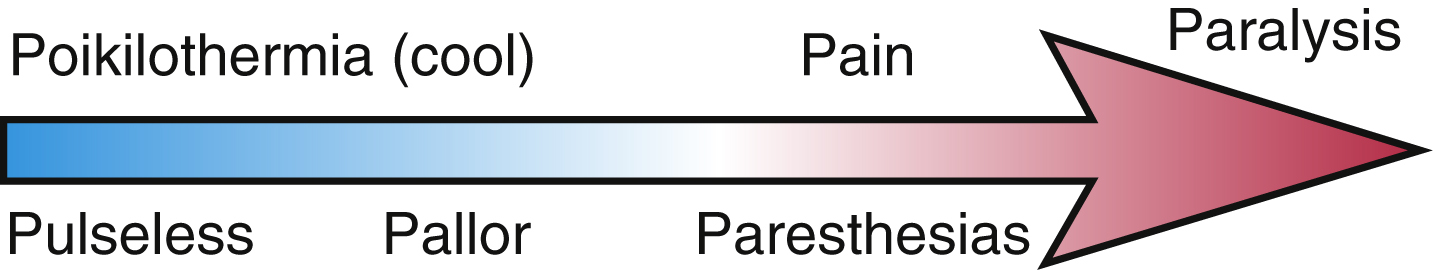 Fig. 3.1, Stages of acute ischemia and clinical manifestations (the “6 P’s”). Overlap of symptoms is common, especially early in the clinical course. Those patients with underlying chronic peripheral artery disease may progress slower than those patients suffering acute limb ischemia without antecedent disease.