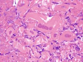 CV Figure 6-8, Histology of HSV esophagitis with evidence of multinucleation, margination of chromatin, and molding of nucleai. Courtesy of Dora Lam-Himlin.