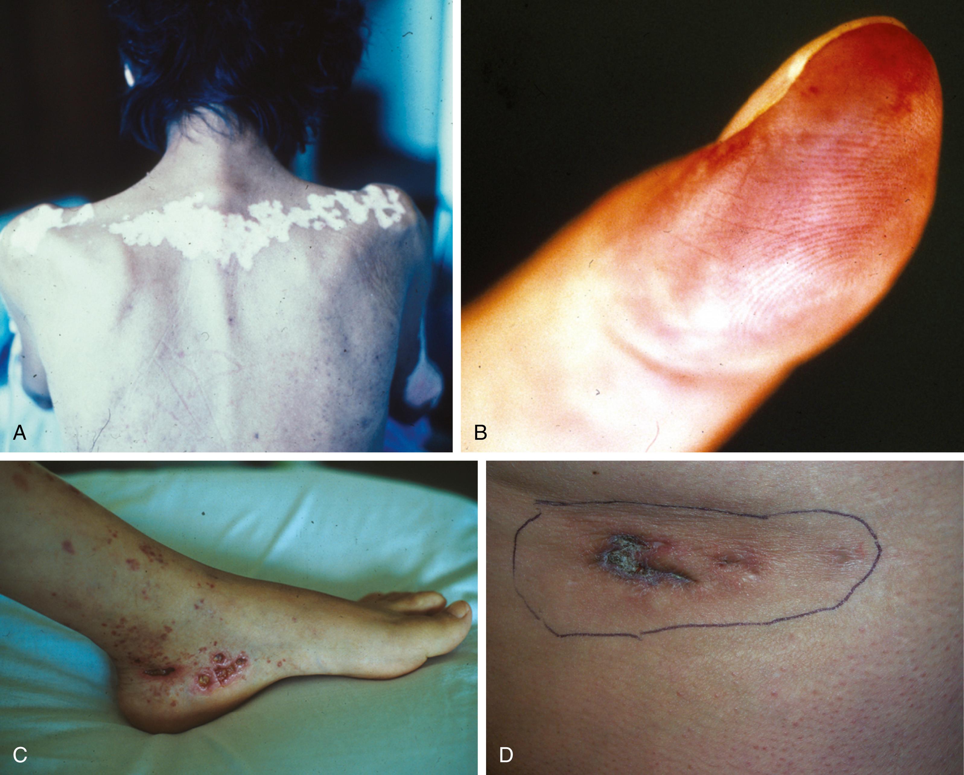 Fig. 53.1, Typical cutaneous lesions in SLE. A, Scarring discoid lesions. B, Finger vasculitis. C, Vasculitis with ulcers. D, Lupus panniculitis.