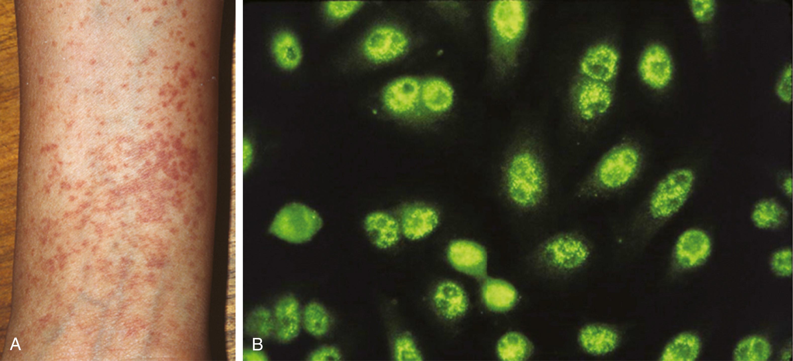 Fig. 53.2, Clinical and laboratory characteristics of Sjögren syndrome. A, Hypergammaglobulinemic purpura with photosensitivity (this patient with primary Sjögren syndrome had a total IgG of 12 g/dL at the time this picture was taken), B, Fine-speckled nuclear pattern in indirect immunofluorescence assay on HEp-2 cells, characteristic for the presence of anti-SSA/Ro autoantibodies.