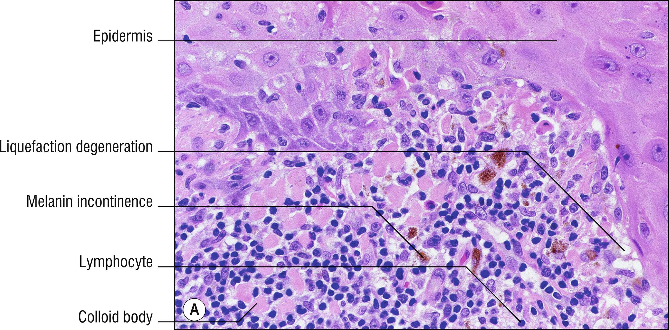 Fig. 1.27, A Colloid bodies.