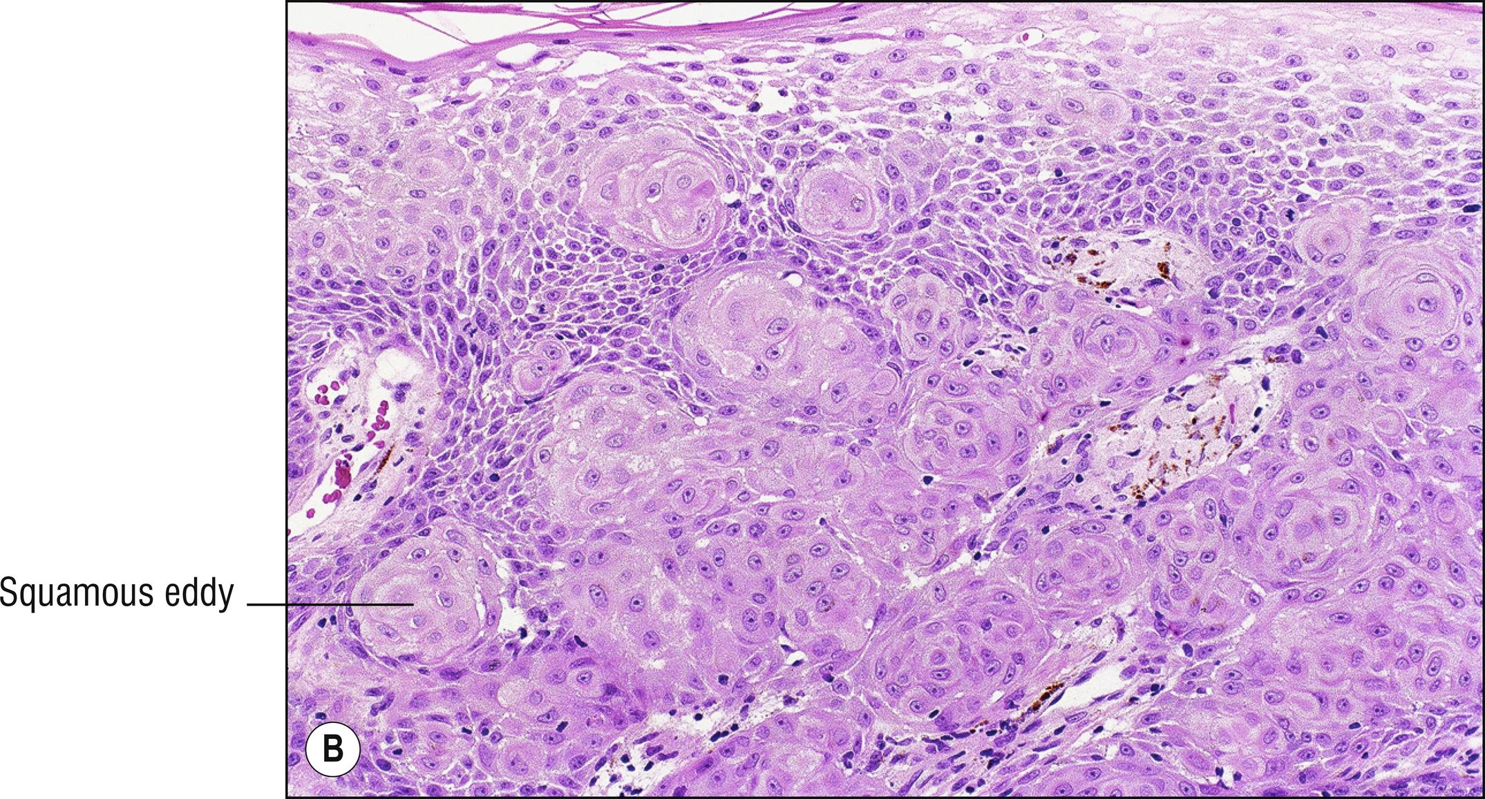 Fig. 1.27, B Squamous eddies in an irritated seborrheic keratosis may be considered a form of dyskeratosis.