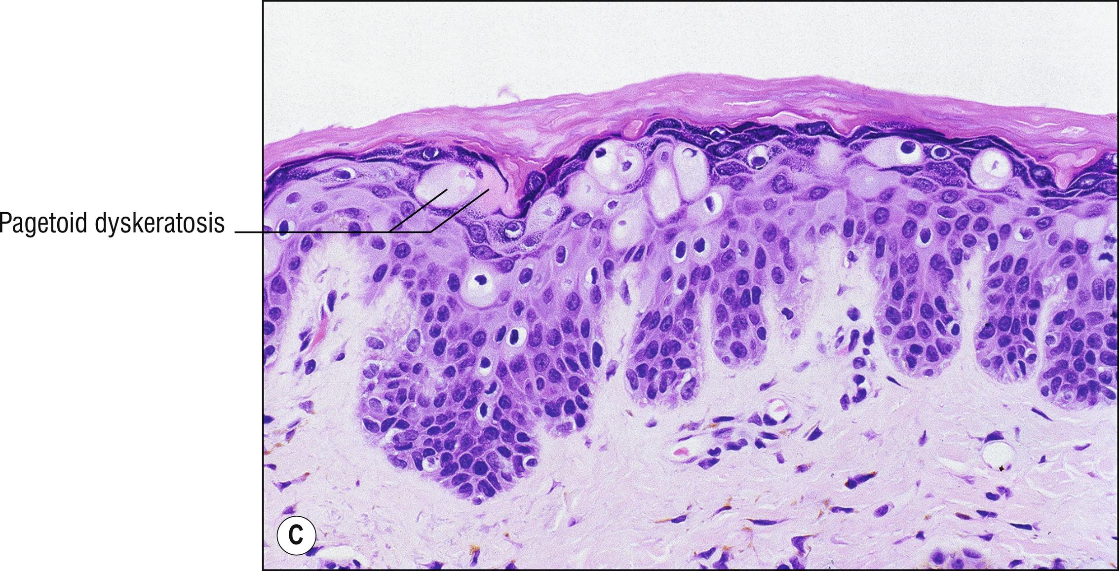 Fig. 1.27, C Pagetoid dyskeratosis.