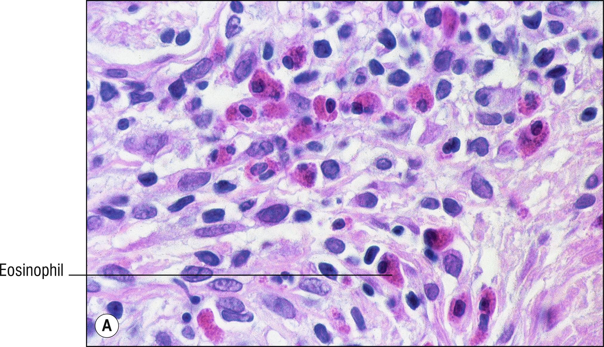 Fig. 1.36, A Eosinophils.