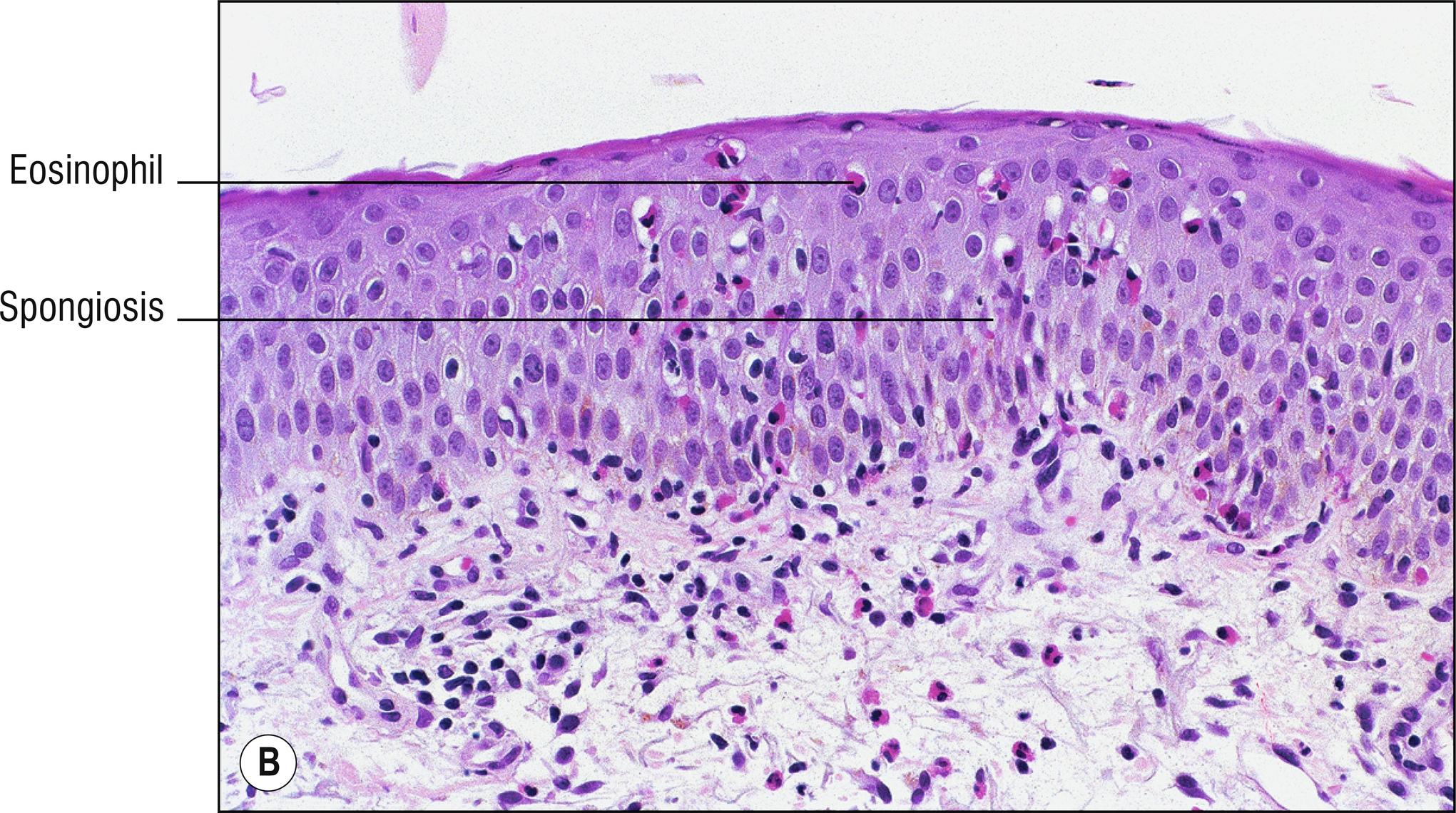 Fig. 1.36, B Eosinophilic spongiosis.