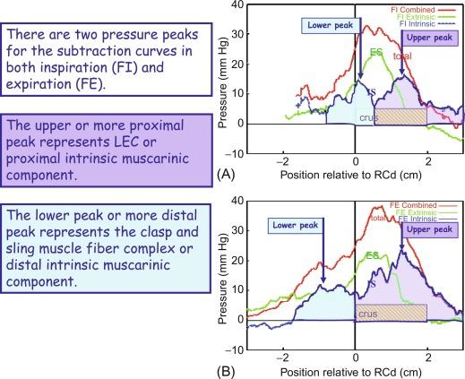 Fig. 22.1, Averaged pressure distributions from pull-throughs referenced to the lower margin of the crus muscles. Panels (A) and (B) show the ensemble averaged inspiratory and expiratory pressure curves in 15 normal volunteers respectively. The red curve is the preatropine pressure curve in both full inspiration (FI) and full expiration (FE). The green curve is the postatropine pressure curve in both FI and FE. The blue curve is the subtraction curve ( red curve minus green curve ). The vertical line at zero on the X axis represents the start of the right crural diaphragm (RCd). The box labeled crus represents the extent of the crural diaphragm on ultrasound imaging. There are two pressure peaks in the subtraction curves in both FI and FE. The upper or more proximal peak reflects a proximal intrinsic muscarinic component. The distal peak reflects a distal intrinsic muscarinic component.