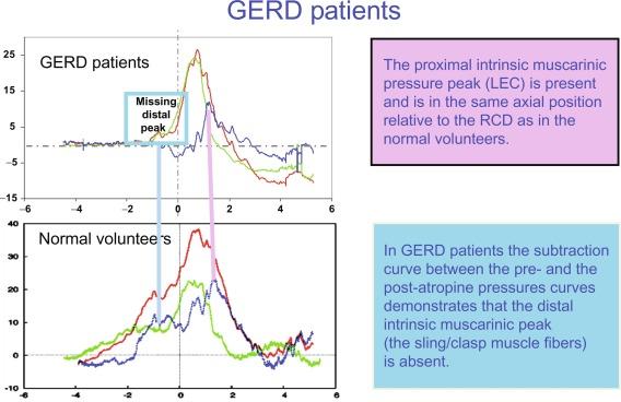 Fig. 22.2, The upper graph represents the ensemble averaged pressure curve in full expiration from seven GERD patients, referenced to right crural diaphragm. The lower graph represents the ensemble averaged pressure curve in full expiration from 15 normal control subjects. Distance is on the X axis and pressure is on the Y axis. The red curve is the preatropine pressure curve, the green curve is the postatropine pressure curve, and the blue curve is the subtraction curve ( red curve minus green curve ). The vertical line at zero on the X axis represents the start of the right crural diaphragm. Note that in the subtraction curve ( blue ), the proximal intrinsic muscarinic pressure peak is present in the GERD patients and is in the same axial position relative to the RCd as in the normal volunteers as demonstrated by the rose colored vertical line on the right. The subtraction curve between the pre- and postatropine pressure curves in GORD patients shows that the distal intrinsic muscarinic peak is absent, as demonstrated by the light turquoise colored line and box on the left.