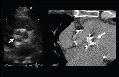 Fig. 4.1, Aortic Valve Calcification.