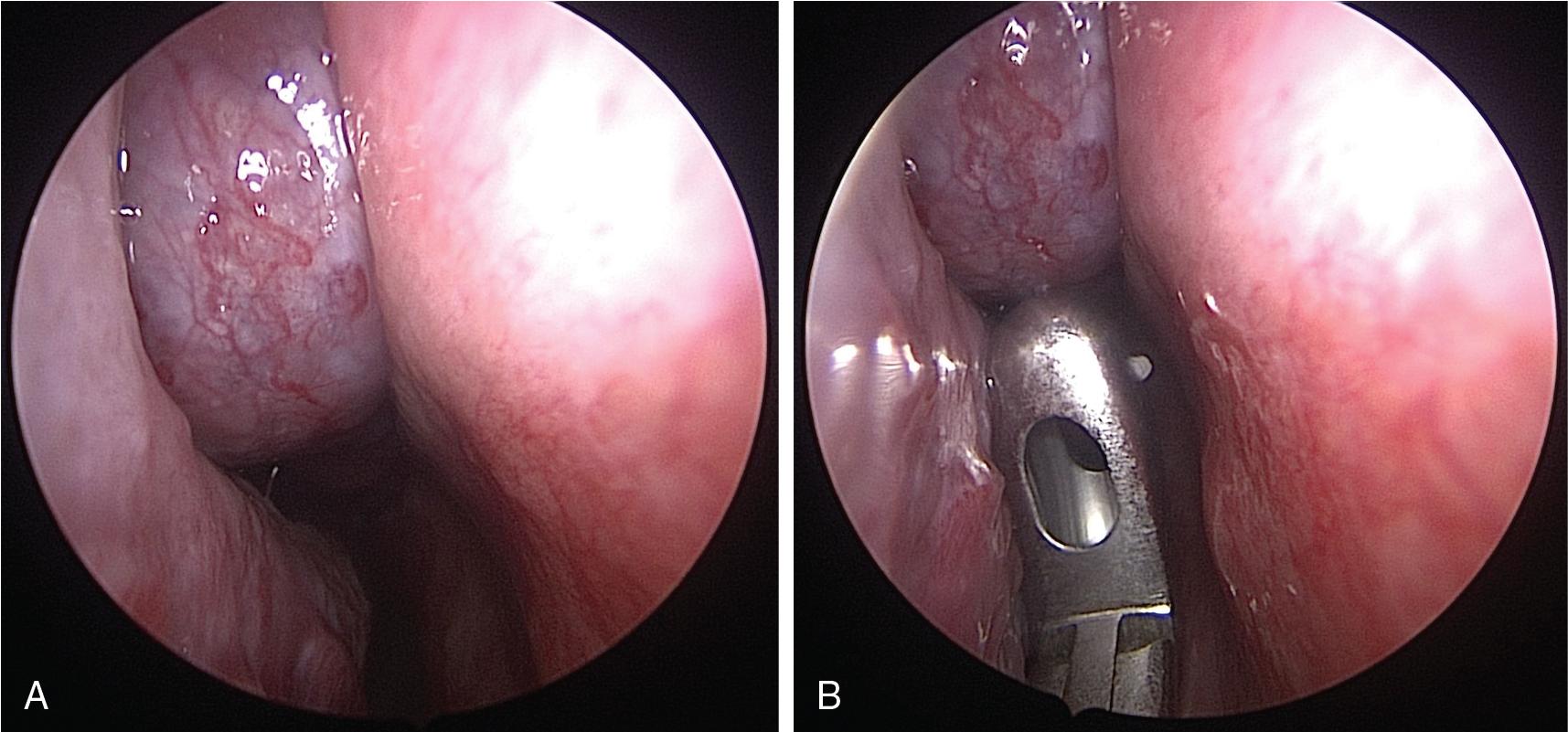 Fig. 26.1, A , Endoscopic view of a right-sided squamous cell carcinoma extending into the nasal cavity from the anterior ethmoids, abutting the right lamina papyracea. B, Endoscopic biopsy performed of the right-sided lesion. Care should be taken not to injure the mucosa of the lateral nasal wall or the nasal septum when performing a biopsy to prevent seeding tumor into adjacent structures.