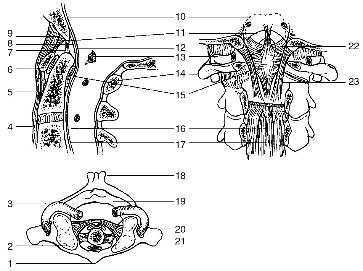 Fig. 1.5, Ligamentous and bony anatomy of the upper cervical region. 1 , Anterior tubercle; 2 , superior articular facet; 3 , vertebral artery; 4 , anterior longitudinal ligament; 5 , anterior atlas-axis membrane; 6 , anterior arch of atlas; 7 , apical ligament; 8 , vertical cruciform ligament; 9 , anterior atlas–occipital membrane; 10 , attachment of tectorial membrane; 11 , anterior edge of foramen magnum; 12 , tectorial membrane; 13 , vertebral artery; 14 , atlas; 15 , transverse ligament; 16 , origin of tectorial membrane; 17 , posterior longitudinal ligament; 18 , spinous process (axis); 19 , atlas; 20 , transverse ligament; 21 , dens (odontoid process); 22 , alar ligament; 23 , deep tectorial membrane.