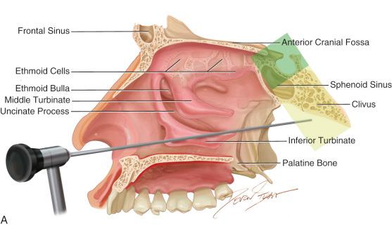 Figure 26.1, Surgical trajectories to clival chordomas. (A) Illustration of the surgical corridor of the endoscopic endonasal approach. The transsphenoidal approach (green) exposes the sella, suprasellar and parasellar regions of the center of the skull base. The transclival endoscopic endonasal approach (yellow) is obtained by removing the clivus inferiorly and provides access to the brainstem in the midline. (B) A midline sagittal plane of a T1-weighted magnetic resonance shows the regions exposed by the transsphenoidal (superior, green) and transclival (inferior, yellow) endonasal approaches. (C) Two surgeons work together during an endoscopic endonasal approach; the endoscope, drill and suction are always in view during removal of the tumor.