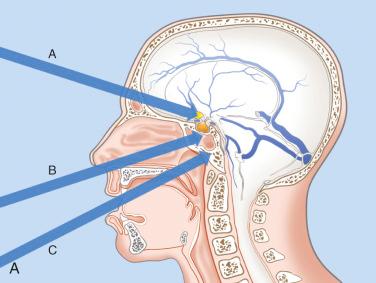 Figure 26.2, The different surgical trajectories to target intracranial chordomas. (A) Anterior approaches: A , subfrontal transbasal; B , transsphenoidal; C , transoral. (B) Of note are the EEA, OZ and FL and their different combinations, which provide a 360-degree access to the posterior fossa. EEA, endoscopic endonasal approach; OZ, orbitozygomatic; MF, middle fossa/subtemporal approach; RS, retrosigmoid; FL, far lateral approach.