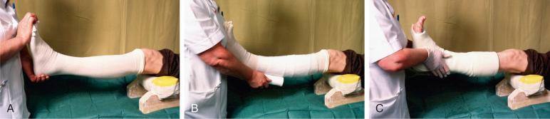 Fig. 7.3, (A) Leg with stockinette applied. Wool is then applied around the head of fibula to protect the popliteal nerve and around the malleoli, heel, and foot as far as the metatarsal heads. (B) Material is rolled on starting at the narrowest part of the limb. (C) A finishing layer with stockinette folded back at the appropriate level to cover rough edges.