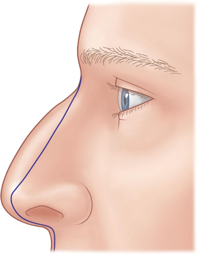 Figure 20.10, The common “straight line” strategy used to plan rhinoplasty. The assumptions implicit here are that the skin sleeve will contract infinitely and uniformly to any skeletal size and shape, and that dorsal and tip resections will affect only those structures. The ideas are all very logical and based on False Assumption Number One; they are just not true.