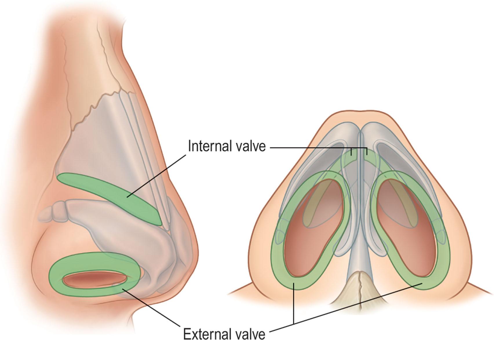 Figure 20.9, The nasal valves. The internal valves are formed by the articulation of the upper lateral cartilages with the anterior (dorsal) septal edge; the external valves are formed by the alar cartilage lateral crura and their associated investing soft-tissue cover.