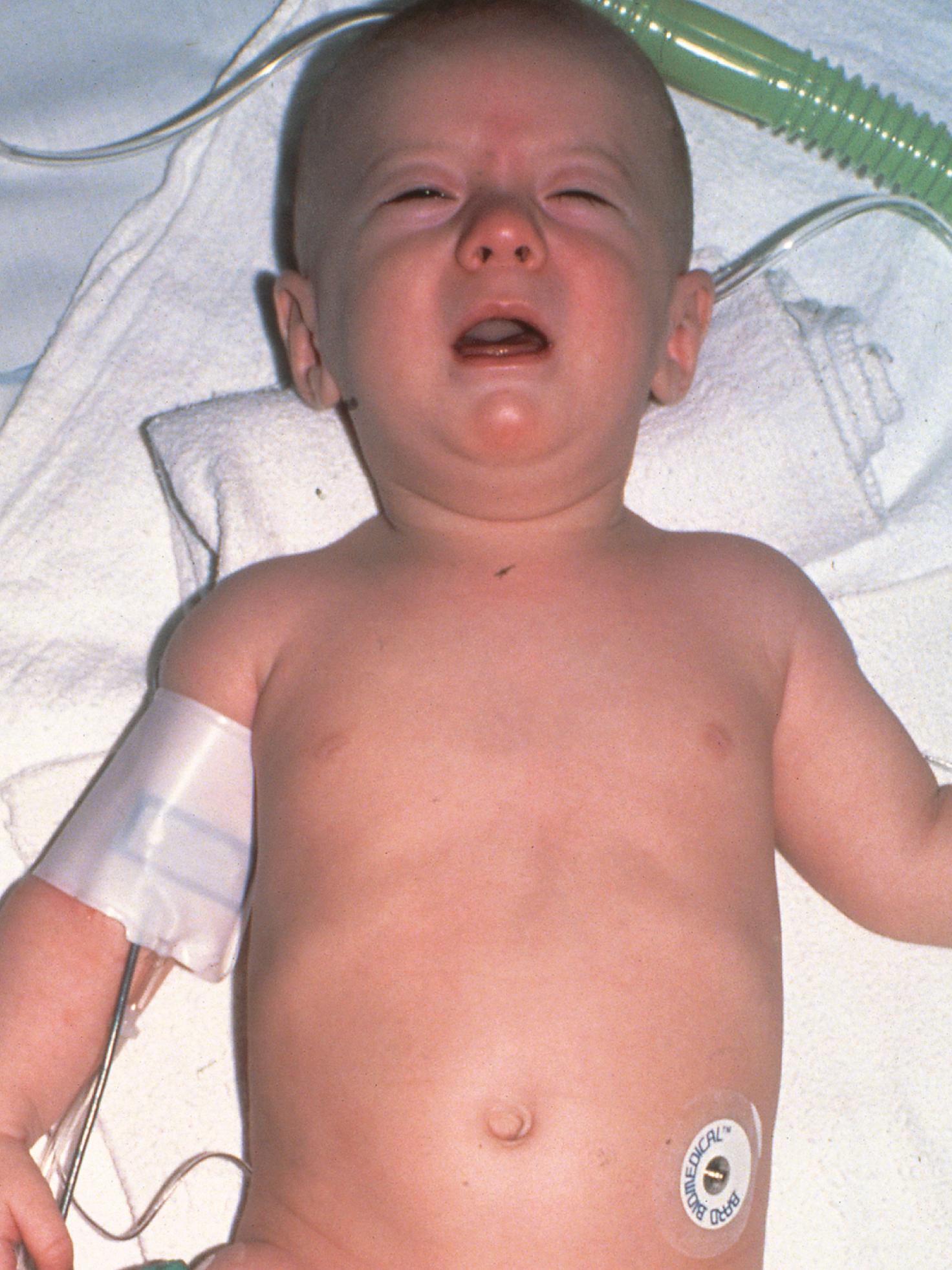 FIGURE 189.4, A 3-month-old infant with botulism just before intubation. Note bilateral ptosis and facial palsy and the absence of tears.