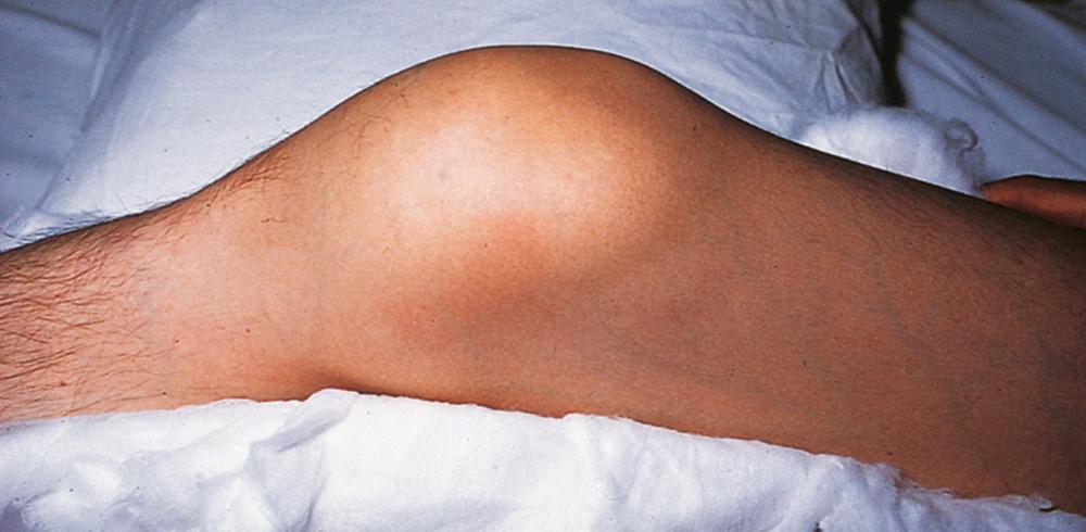 FIGURE 160-1, Acute hemarthrosis of the knee is a common complication of hemophilia.