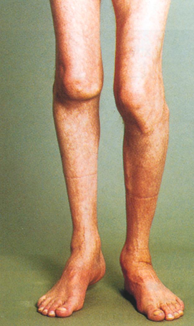 FIGURE 160-2, Severe chronic arthritis in hemophilia.