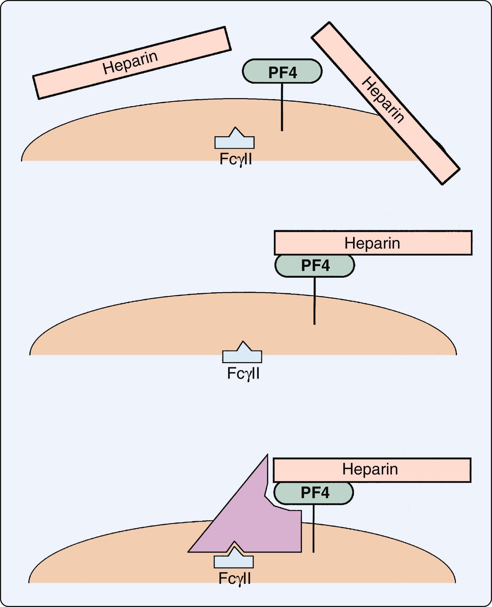 Figure 28.9, The pathogenesis of heparin-induced thrombocytopenia. Top panel: Platelet factor 4 (PF4) released from platelet granules is bound to the platelet surface. Middle panel: Heparin and PF4 complexes form. Bottom panel: The antibody binds to the PF4-heparin complex and activates platelet FcγII receptors.