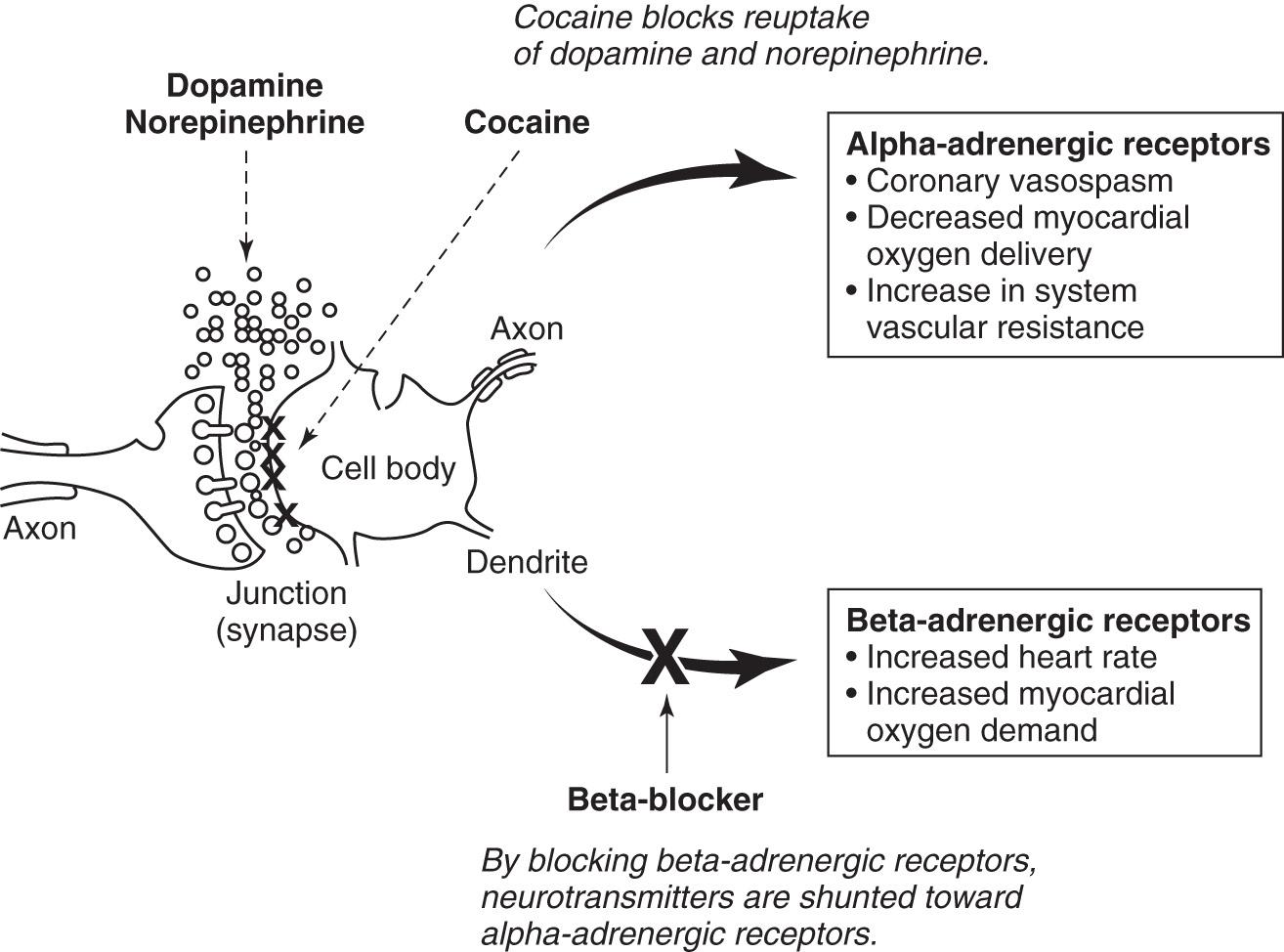 Fig. 49.1, Proposed potential mechanism of the cardiovascular effects of cocaine when beta-blockers are administered in cocaine-induced acute coronary syndrome.