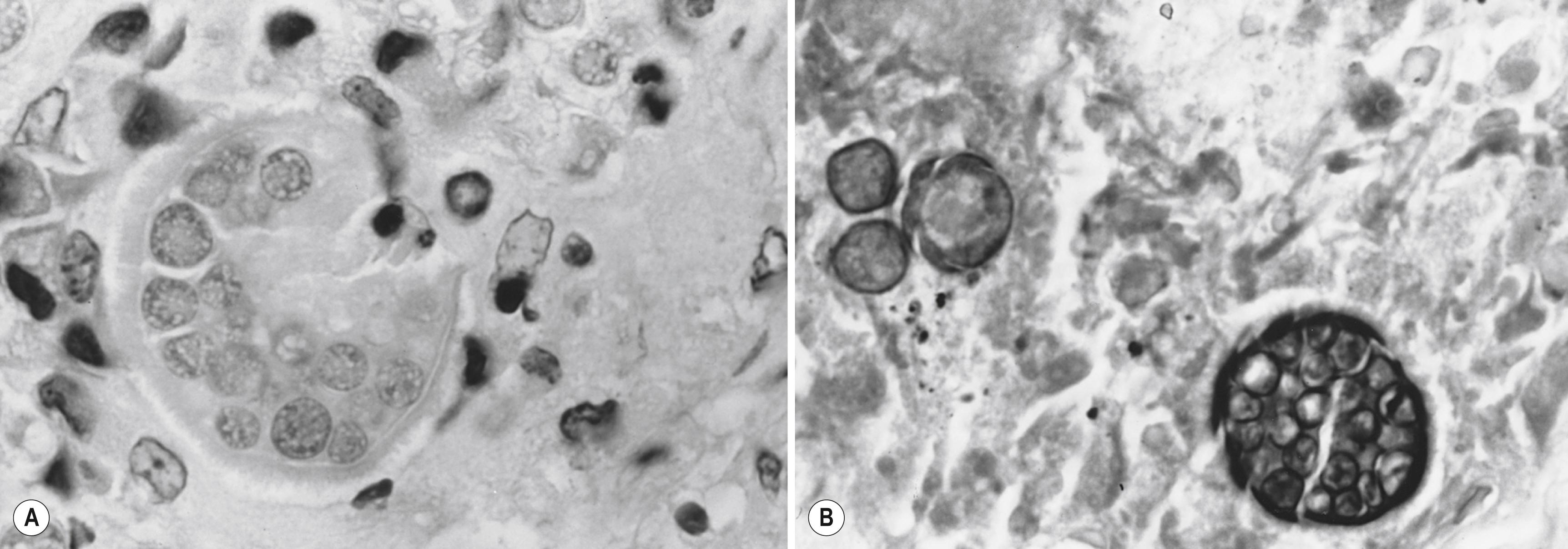 Figure 253.2, Specimens from a patient with AIDS and pneumonia caused by Coccidioides immitis. (A) Ruptured endosporulating spherule containing endospores 2–5 μm in diameter (hematoxylin and eosin stain, ×1250). (B) Typical intact, large endosporulating spherule and three immature spherules (Gomori methenamine silver nitrate stain, ×1000).