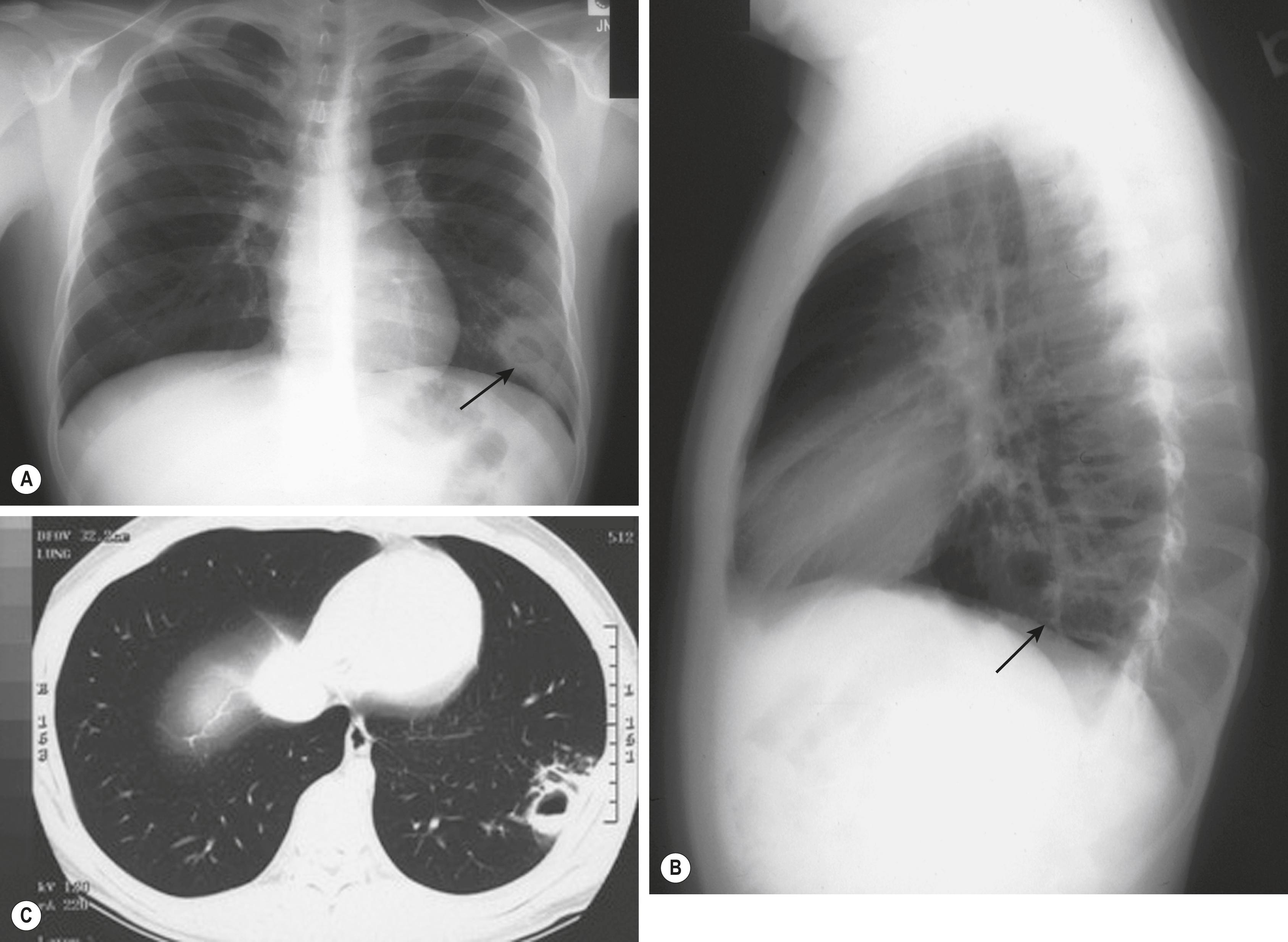 Figure 253.4, A 14-year-old boy with type 2 diabetes mellitus had a 6-month history of occasional chest pain and 13.6 kg (30 lb) weight loss. Chest radiographs (A and B) show peripheral left lower-lobe lung abscess (arrows) ; computed tomography (lung window) shows air–fluid level (C). Aspirate yielded growth of Coccidioides immitis.