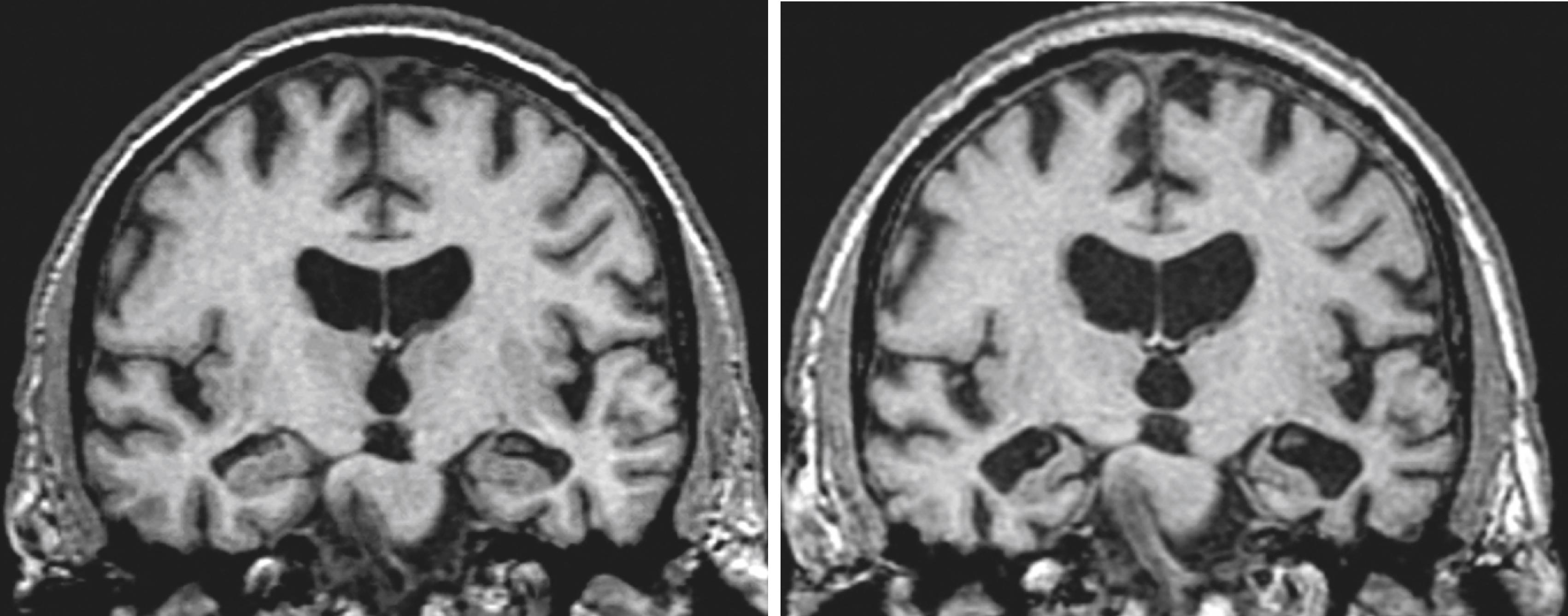 FIGURE 371-3, Serial coronal images from magnetic resonance imaging of a patient with Alzheimer disease.