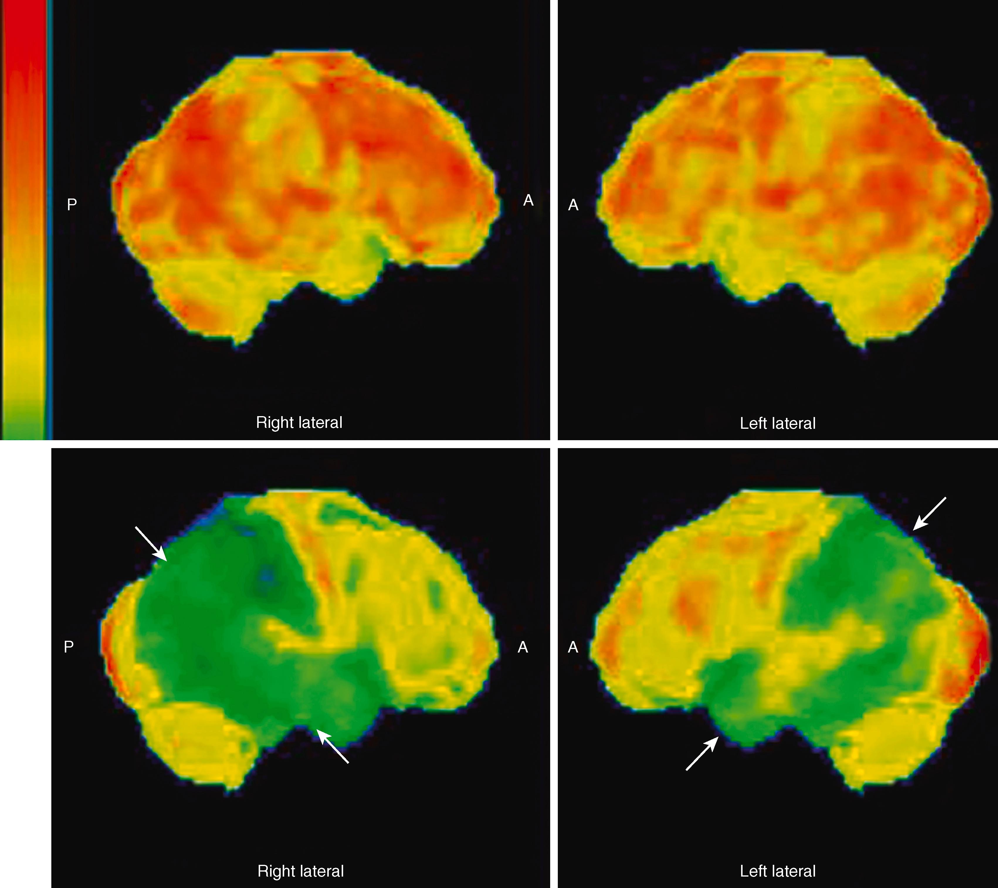 FIGURE 371-4, 18 Fluorodeoxyglucose positron emission tomographic scan of a patient with Alzheimer disease dementia.