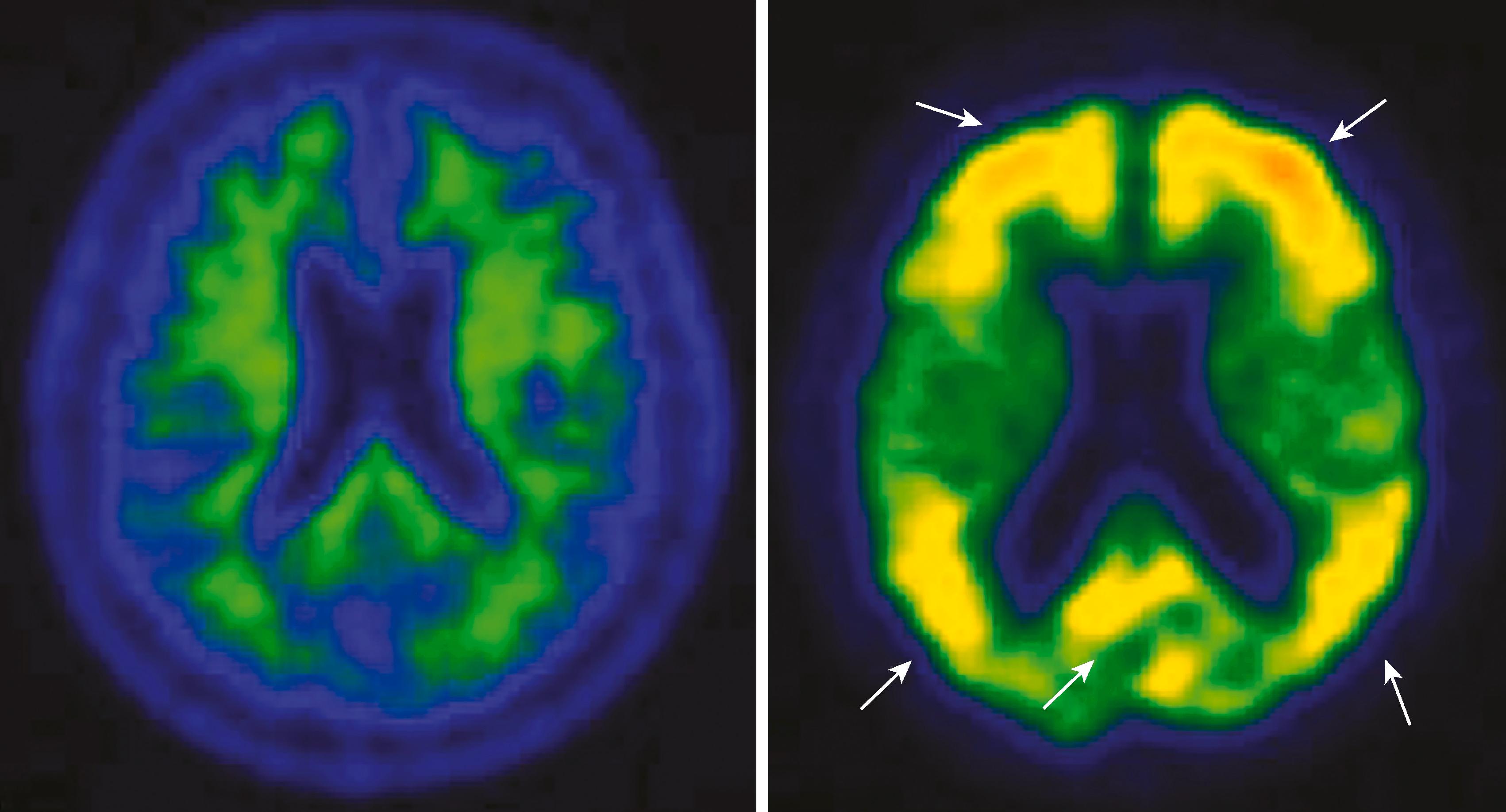 FIGURE 371-5, Amyloid positron emission tomographic (PET) scan of a patient with Alzheimer disease dementia.