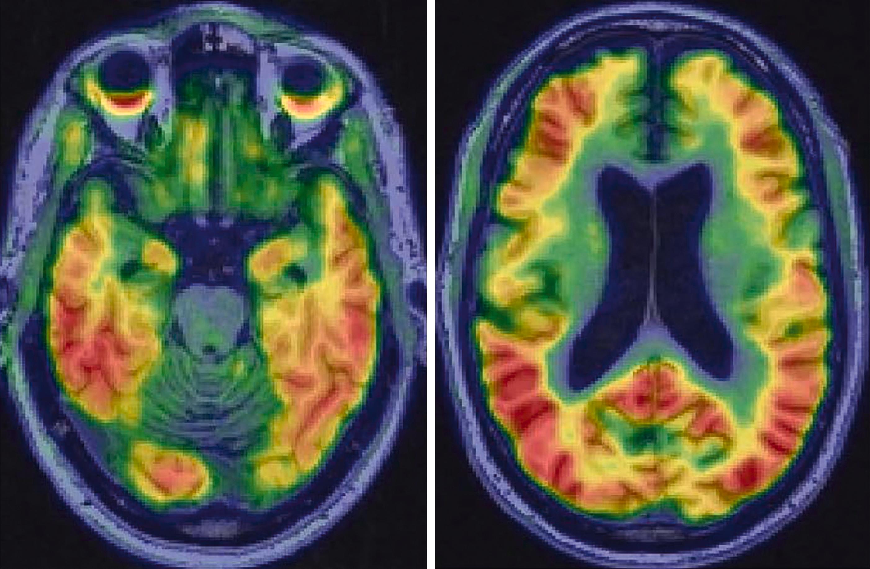 FIGURE 371-6, AV1451 (tau) positron emission tomographic (PET) scan of a patient with Alzheimer disease dementia.