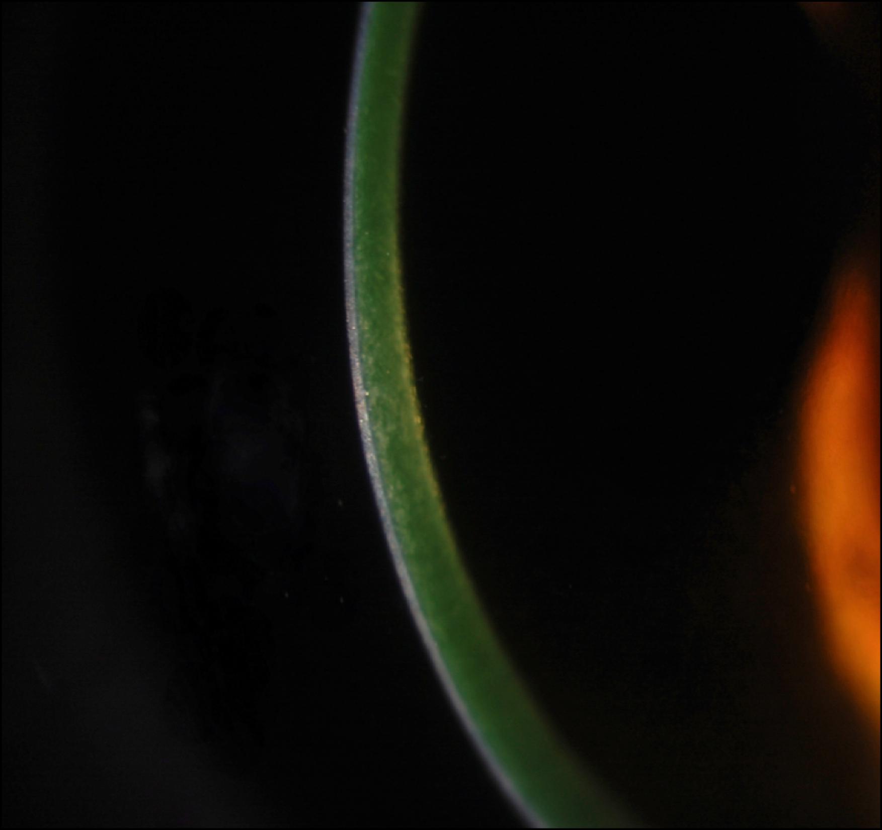 Fig. 152.3, Riboflavin penetration into the cornea stroma.