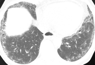 Figure 23.1, A 51-year-old woman with dermatomyositis and a diagnosis of nonspecific interstitial pneumonia on surgical lung biopsy. High-resolution CT demonstrates peripheral ground-glass opacities and reticulation in the lower lobes, with relative subpleural sparing.