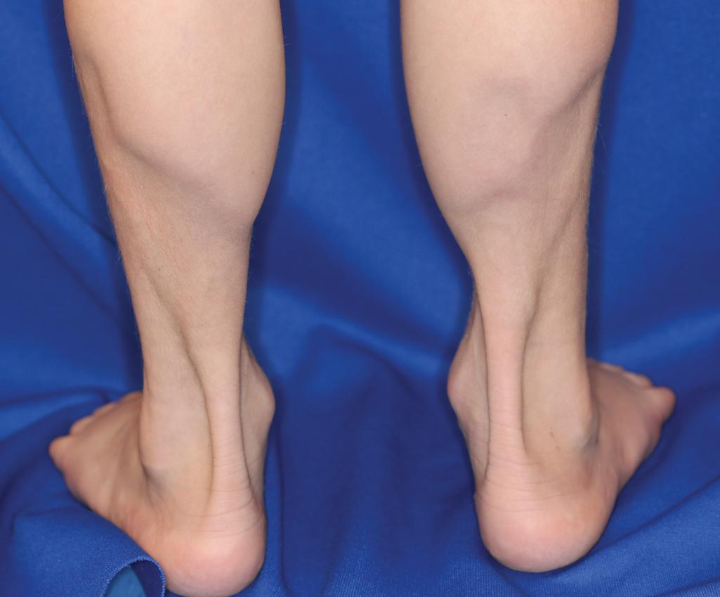 Fig. 22.12, Lipoatrophic panniculitis of the ankles. This 5-year-old boy developed erythematous plaques that resolves with marked atrophy of the ankles and lower calves. No systemic disorders were discovered, and his disease progression was slowed by administration of systemic corticosteroids and methotrexate.