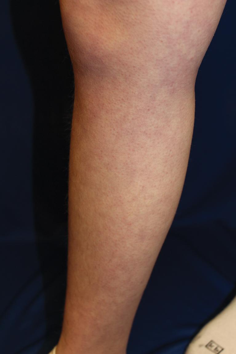 Fig. 22.13, Livedo reticularis. Bluish-red reticulated discoloration of the leg in a teenager with systemic lupus erythematosus.