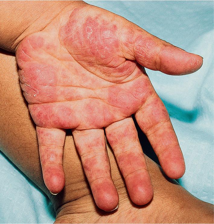 Fig. 22.14, Systemic lupus erythematosus. Erythema and papular telangiectasia on the palm and fingers of a child with lupus erythematosus.